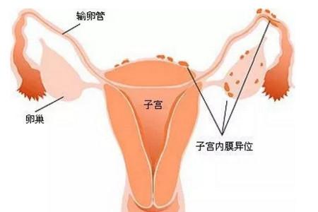 b超检查出少量盆腔积液怎么回事