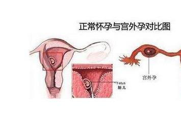 孕期没看到孕囊就是宫外孕吗