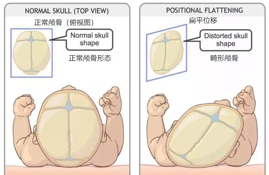 宝宝可以仰卧位睡觉吗 宝宝会睡成平头、偏头吗