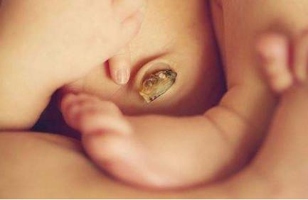 新生儿肚脐出血怎么办？