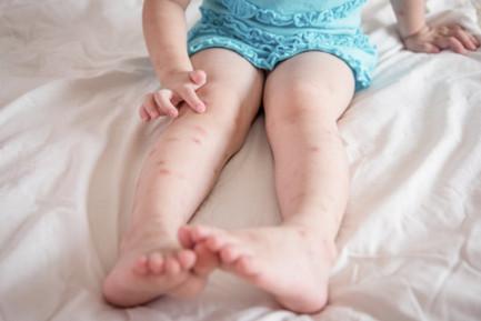 宝宝皮肤擦伤怎么处理