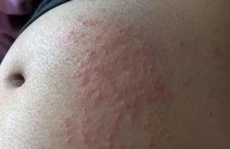 孕妇患湿疹能用什么药