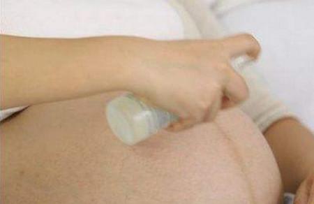 如何去除妊娠纹