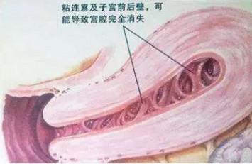 宫腔粘连有哪些表现