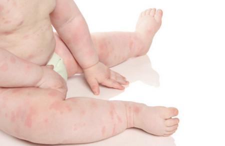 宝宝过敏的症状有哪些