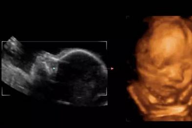 產(chǎn)檢四維和三維的區(qū)別在哪