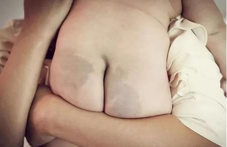 宝宝屁股“淤青会影响健康吗