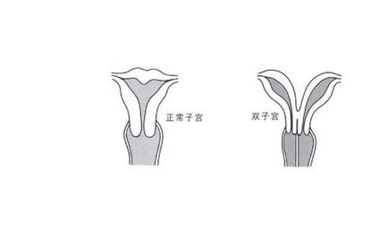 双子宫对怀孕有影响吗