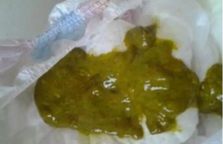 怎么根据宝宝大便颜色辨病呢？