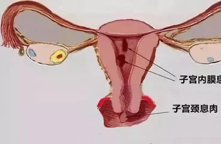 子宫内膜息肉要紧吗