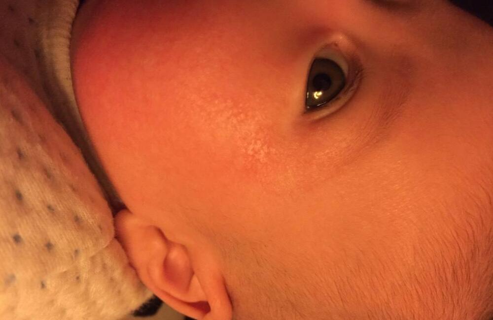 小儿干性湿疹的症状