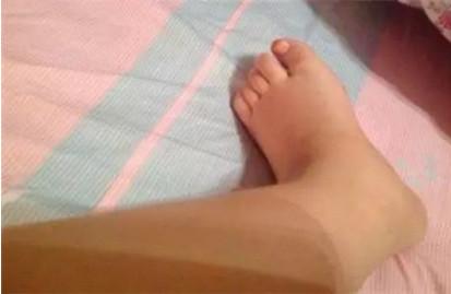孕妈为什么会出现脚肿？