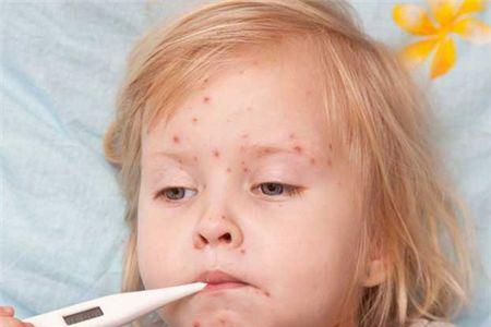 宝宝出水痘第几天最严重