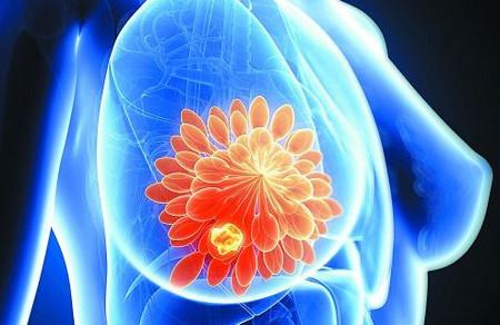 乳腺癌在心理上要注意什么