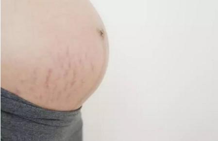 预防妊娠纹孕期做好这4点