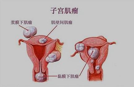 子宫肌瘤不治疗危害大吗