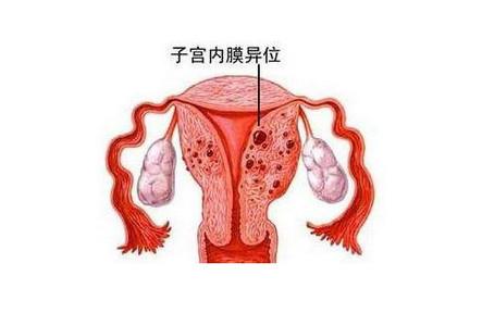 这4个异常可能是子宫内膜异位症
