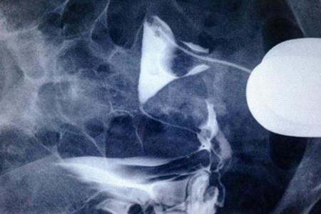 检查输卵管造影还是通液