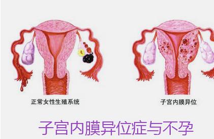 子宫内膜异位症是怎么回事