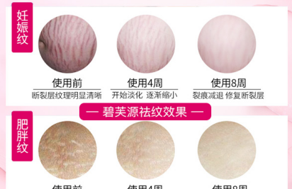 怎么能去掉妊娠纹 高端去纹成为无纹女人