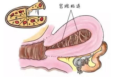宫腔粘连了还能自然怀孕吗？