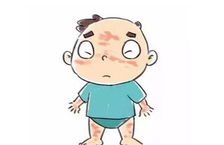 小儿色素荨麻疹预防措施