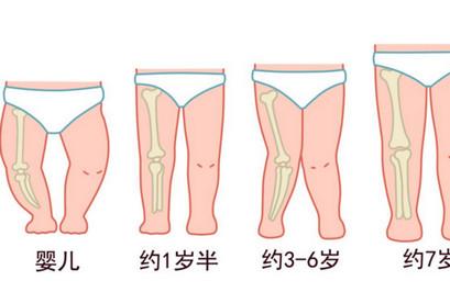 担心宝宝长成O型腿怎么办