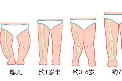 担心宝宝长成O型腿怎么办
