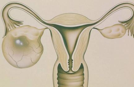 卵巢囊肿是良性还是恶性怎么知道