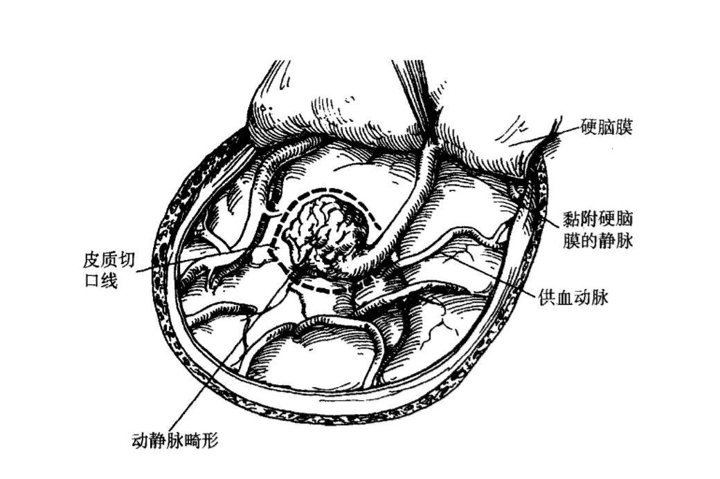 小儿神经管畸形的症状