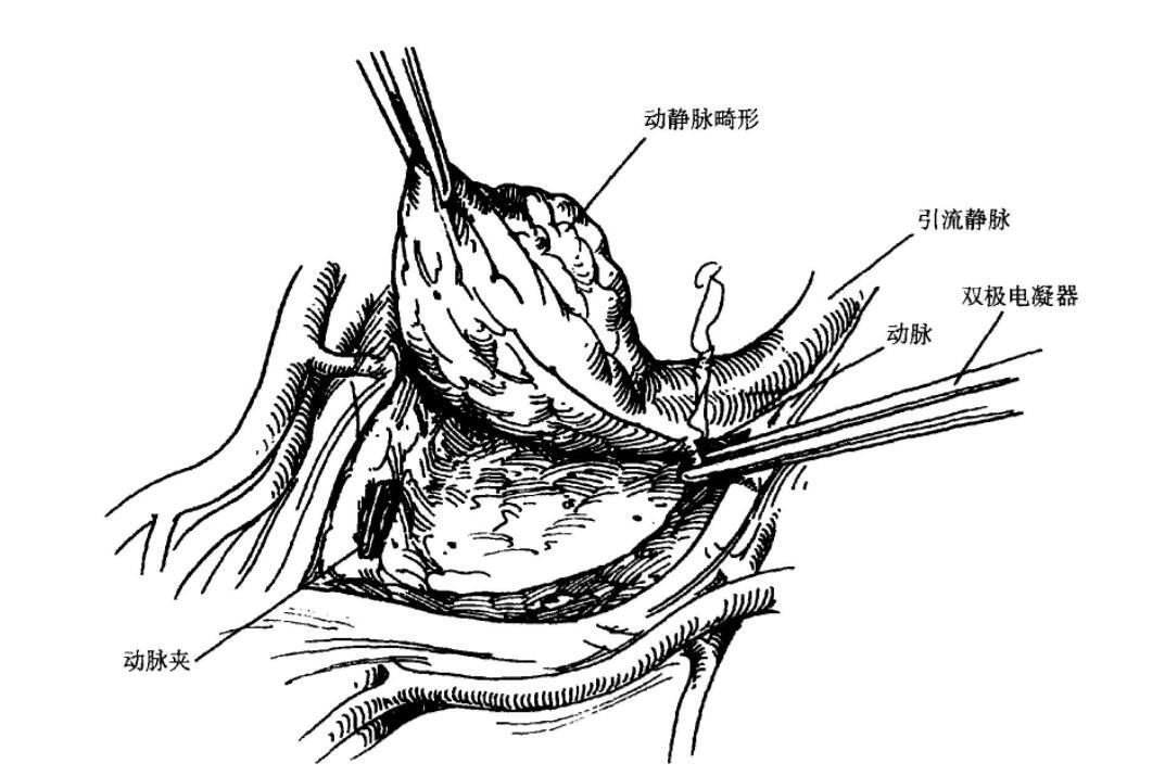 小儿神经管畸形是怎么引起的