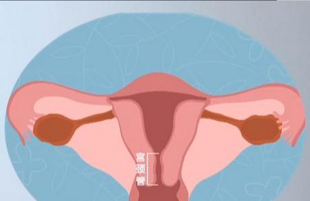 孕期宫颈管短的风险有哪些