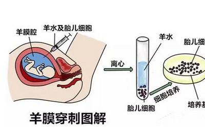 无创、唐筛、羊水穿刺怎么选