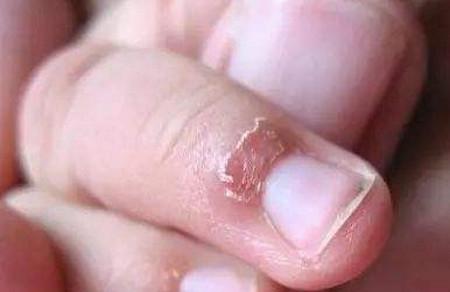 宝宝手上有倒刺真的是缺乏维生素吗？
