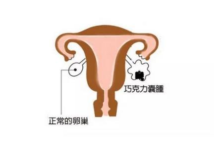 巧囊会影响怀孕吗 怎样预防巧囊形成