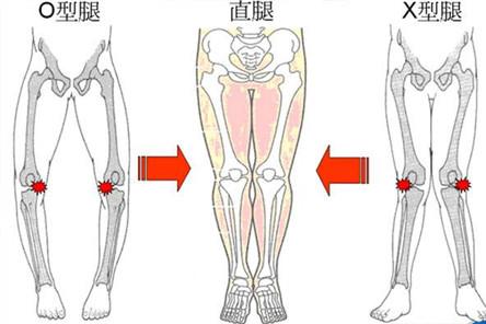 罗圈腿是天生的吗 罗圈腿怎么矫正？