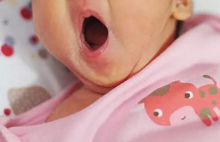 新生儿黄疸需小心该怎么办
