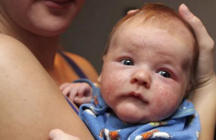 湿疹宝宝要不要查过敏原