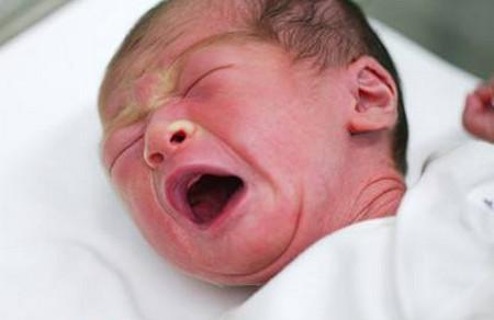 新生儿黄疸怎样尽早排出？