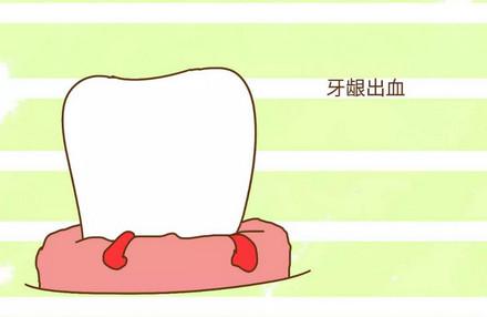 孕期牙龈出血怎么缓解
