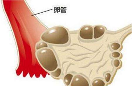 多囊卵巢综合征想怀孕怎么办？
