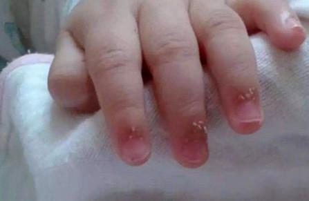 宝宝手指长倒刺是因为缺乏维生素吗？