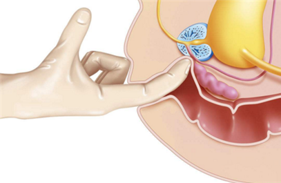 前列腺检查前需要禁欲几天 检查前列腺一定要禁欲吗？