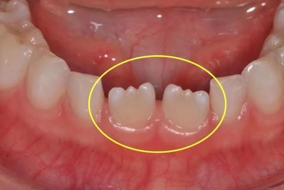 小孩牙齿为什么呈锯齿状？