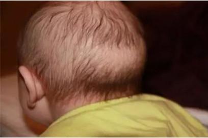 宝宝后脑勺头发少是怎么回事儿？