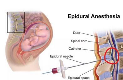 怎么了解分娩镇痛