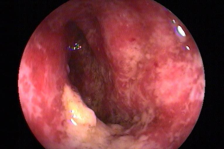 小儿溃疡性结肠炎的症状是什么