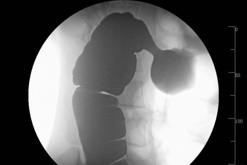 小儿溃疡性结肠炎怎么办