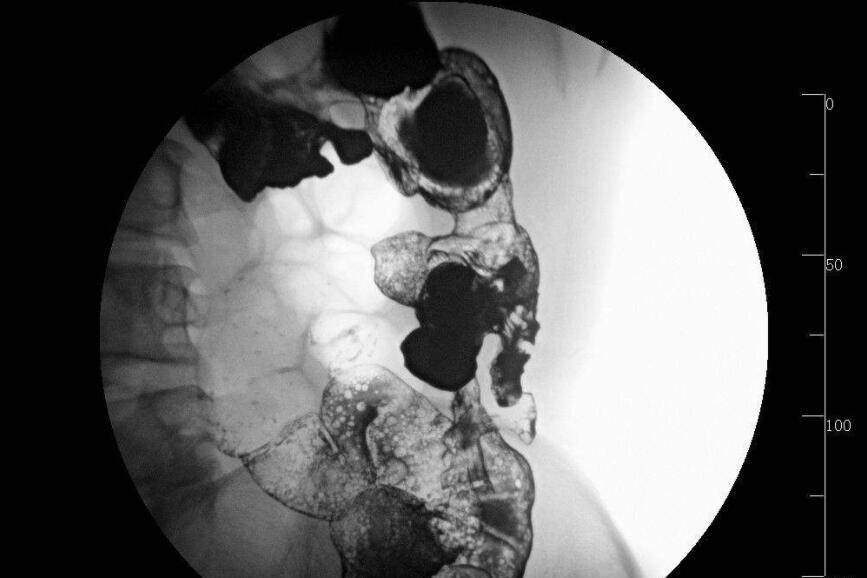 小儿溃疡性结肠炎的并发症