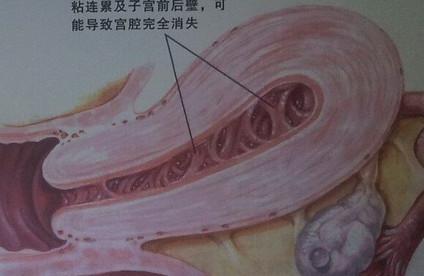 做过流产怀不上，要小心宫腔粘连！